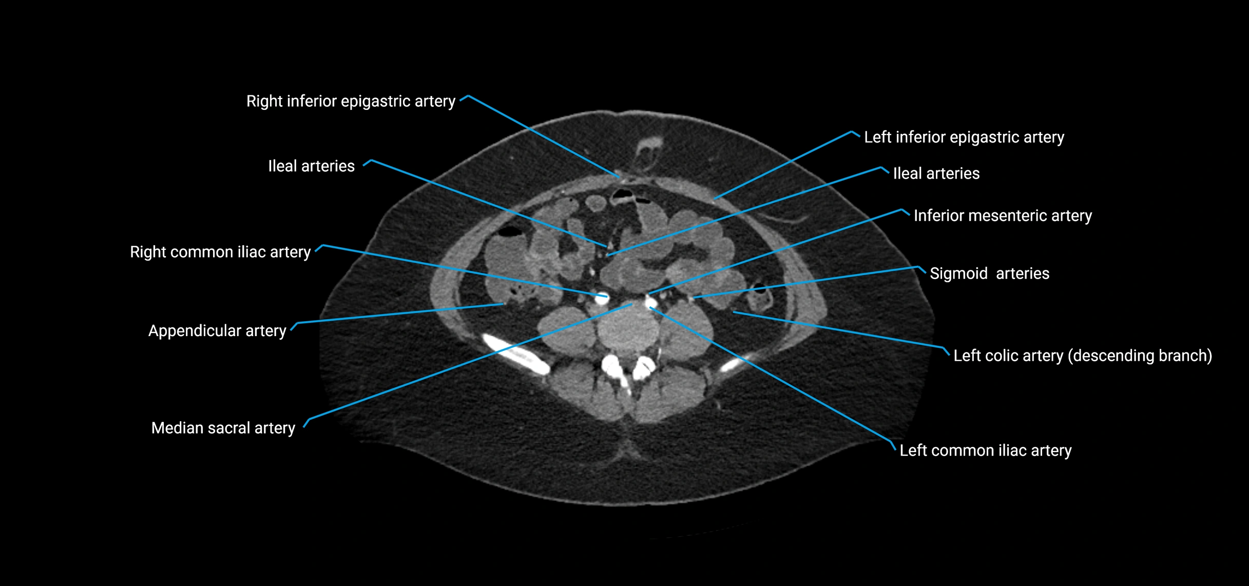 CTA abdomen axial cross sectional anatomy labelled image_153 (2).webp
